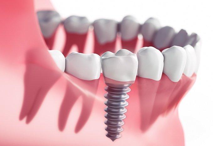 Акція на імплантацію зубів