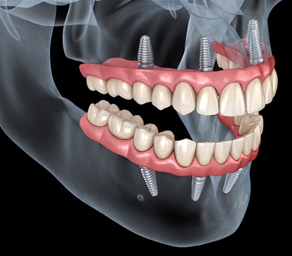 Імплантація зубів all-on-4