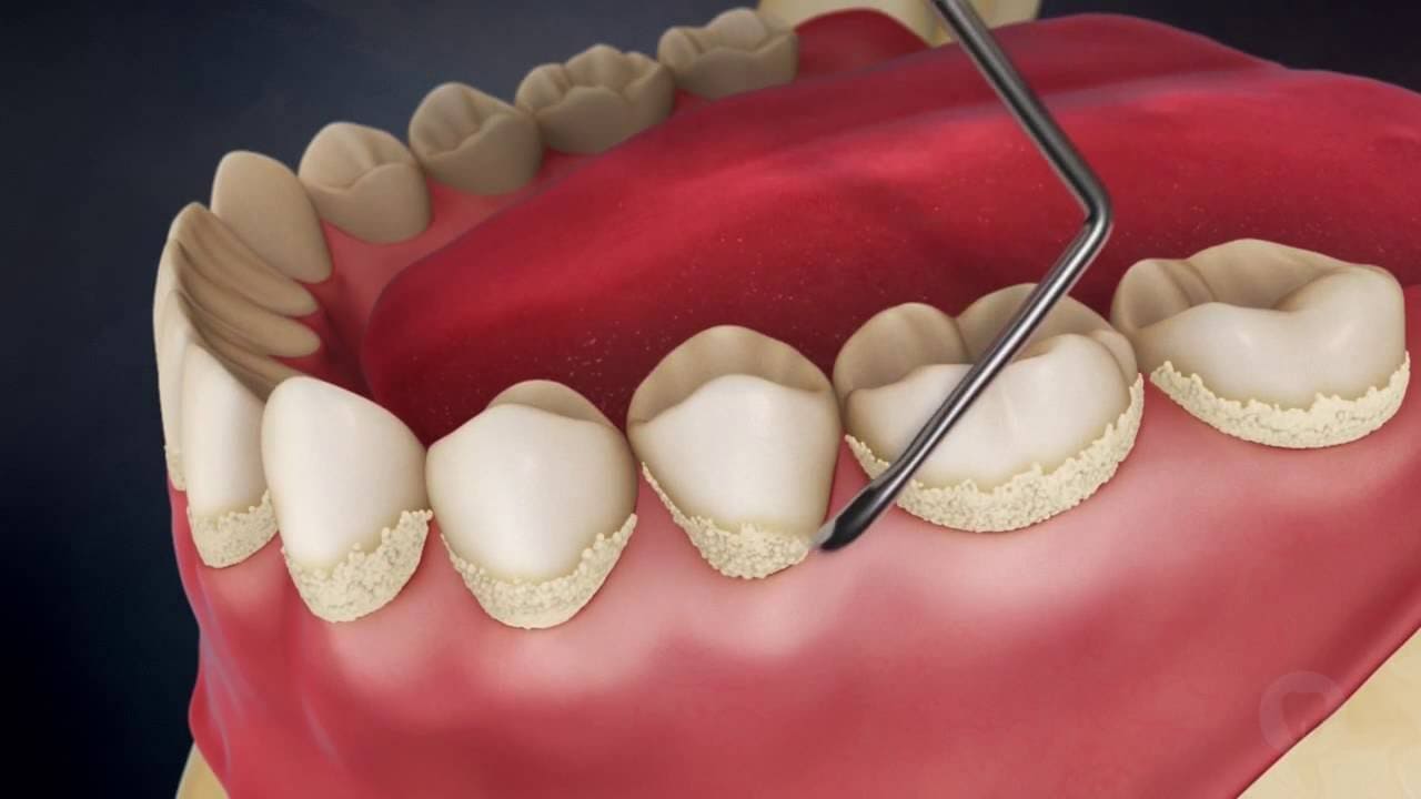 Зубний наліт: причини, наслідки та шляхи його усунення