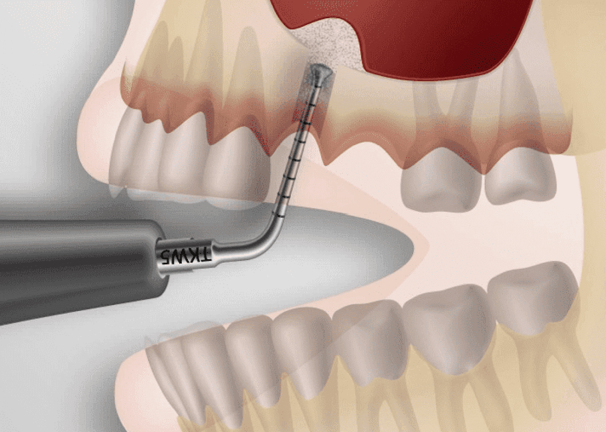 Синус-ліфтинг: сучасна стоматологія